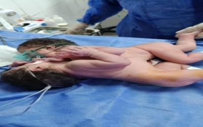 توأم ملتصق يولد في مستشفى الفيوم العام