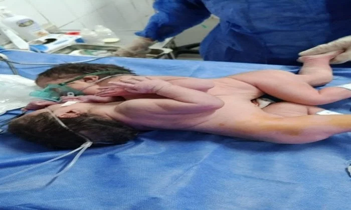 توأم ملتصق يولد في مستشفى الفيوم العام
