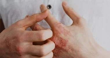 وزارة الصحة توجة رسائل هامة للحماية من الإصابة بالأمراض الجلدية فى الصيف