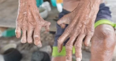 وزارة الصحة توفر علاج الجذام مجانا بعيادات الجلدية التخصصية بجميع المحافظات